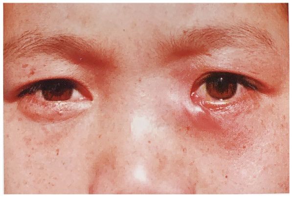 慢性泪囊炎最有效的治疗,急性泪囊炎和慢性泪囊炎的区别