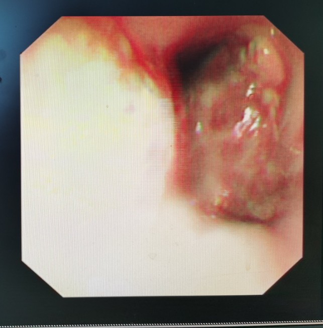 贲门癌吐血抢救,中国最著名的贲门癌治疗专家