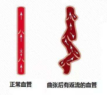 精索静脉是干嘛的,什么是精索静脉曲张精索是干嘛的