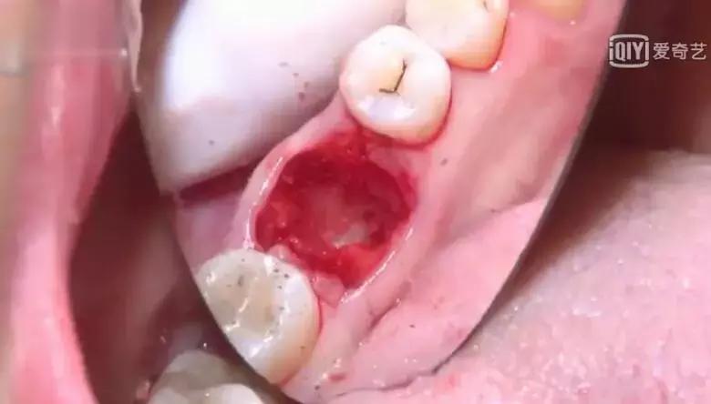 盘点那些看着都很疼的拔牙方法,拔牙过程的操作步骤及注意事项