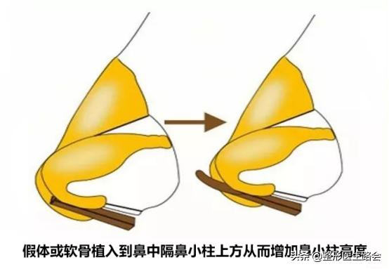 鼻翼缩小鼻骨内推手术,宽鼻头缩窄手术好做吗
