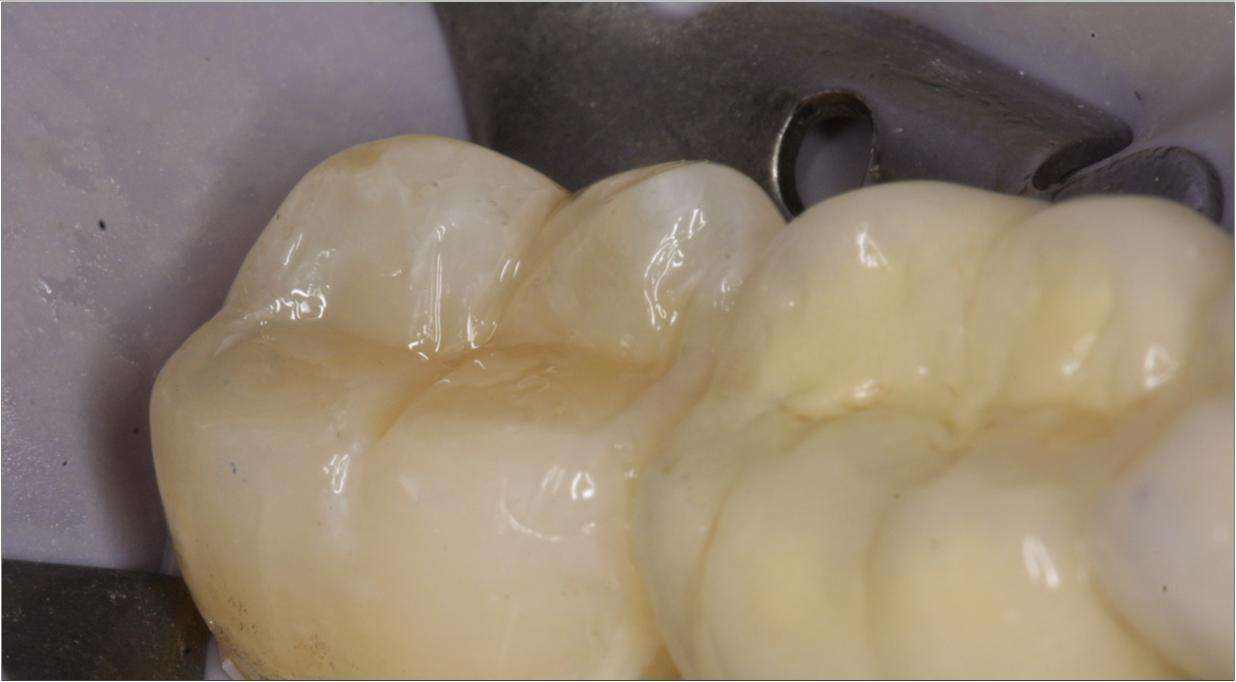 补牙太贵了五百块,补牙有300多和200多的差别在哪里