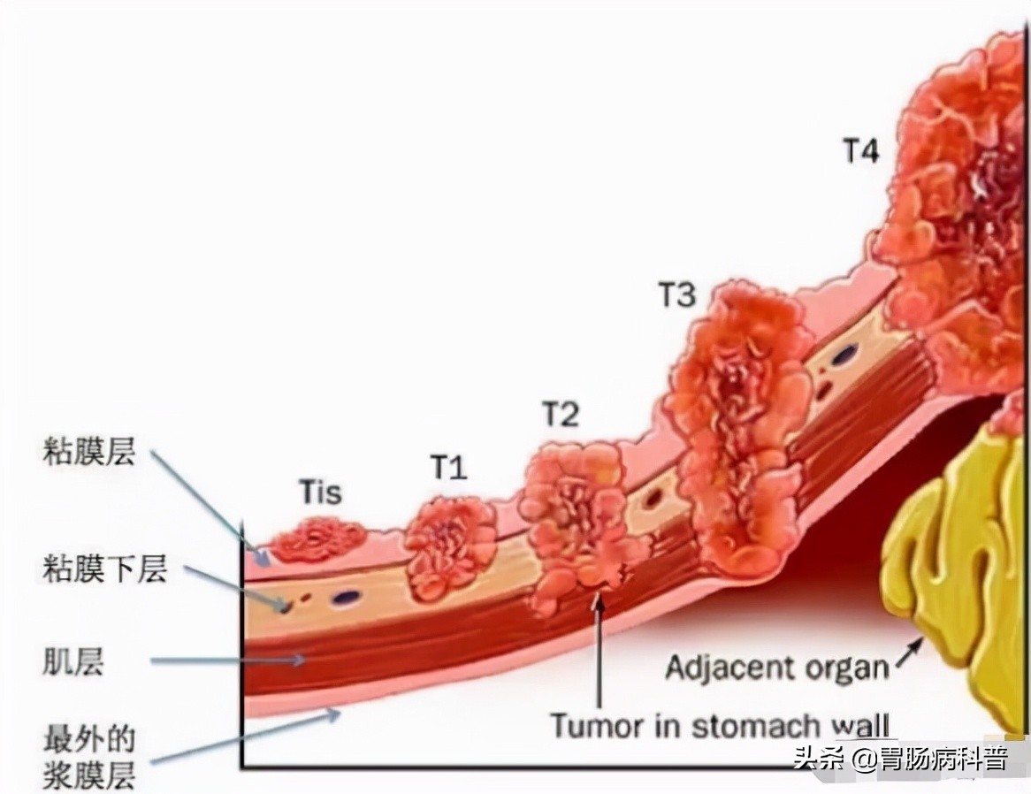 拔鱼刺胃癌早期,取一个鱼刺去了一趟医院