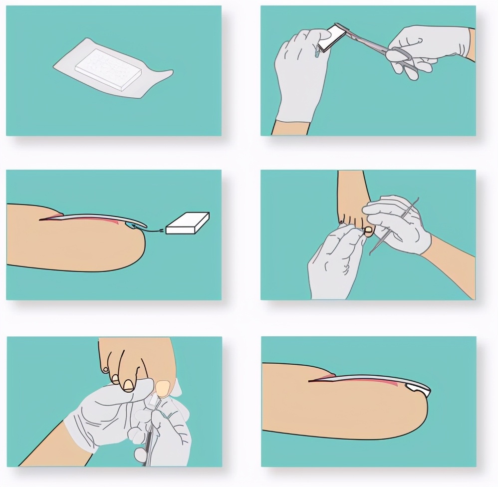 反复发作的甲沟炎应考虑什么疾病,甲沟炎注意事项及禁忌