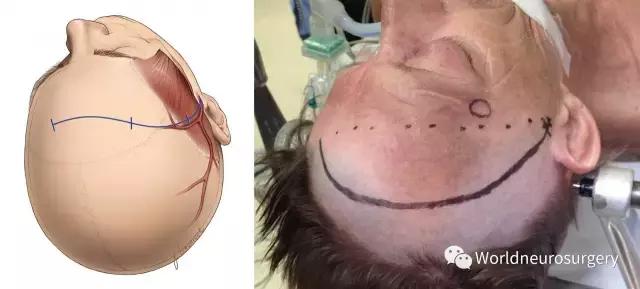 翼点入路的开颅要点,翼点开颅详解图