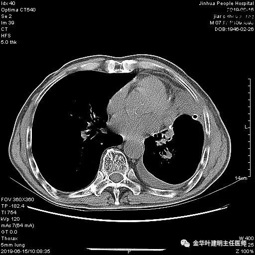 肺手术后乳糜胸是医疗事故吗,肺部切除后乳糜胸治好了