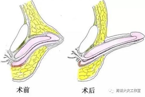 家长带孩子割包皮攻略,家长割包皮