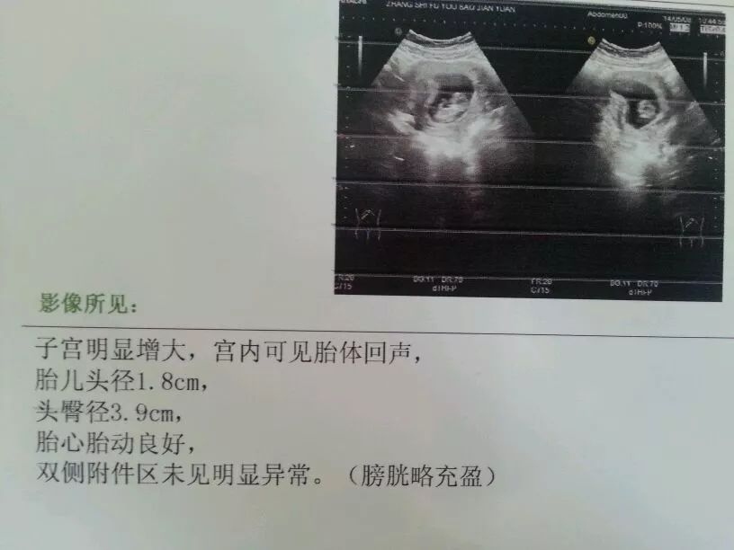 产前大出血造成流产?产检的注意事项,准妈妈们要注意收藏