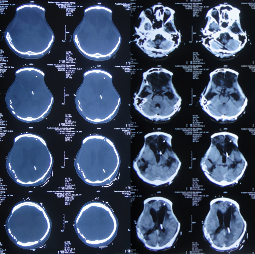 脑受伤开颅手术昏迷,开颅手术后20天发生脑积水引流