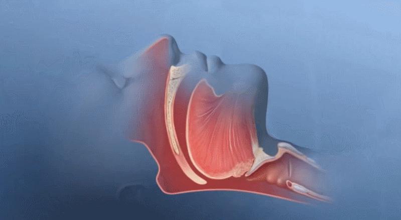 睡眠呼吸机治疗打鼾需要佩戴多久,睡眠呼吸机治疗打鼾吗