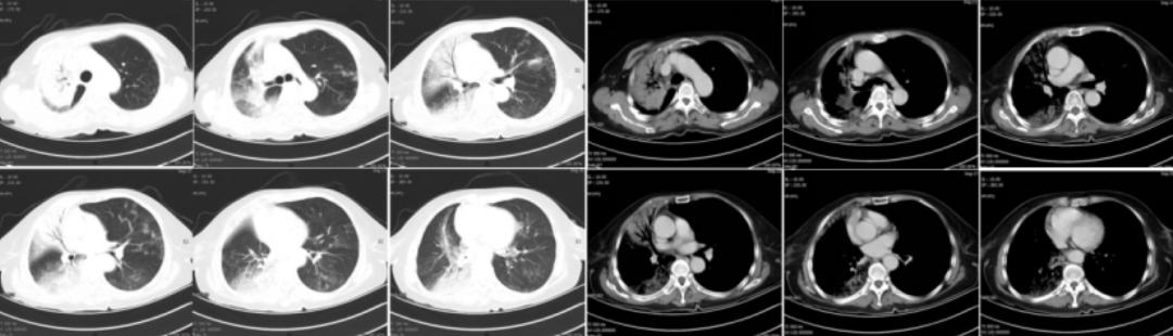 时隔一年再次住院,时隔一年旧病复发