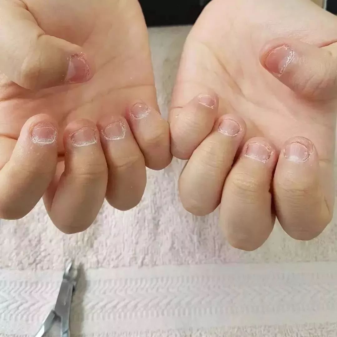 儿童啃指甲把指甲啃秃的坏处,儿童爱啃指甲长大能自愈吗
