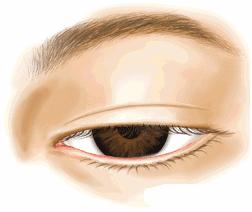 双眼皮消肿以后还是变宽,双眼皮吃什么药消肿比较快