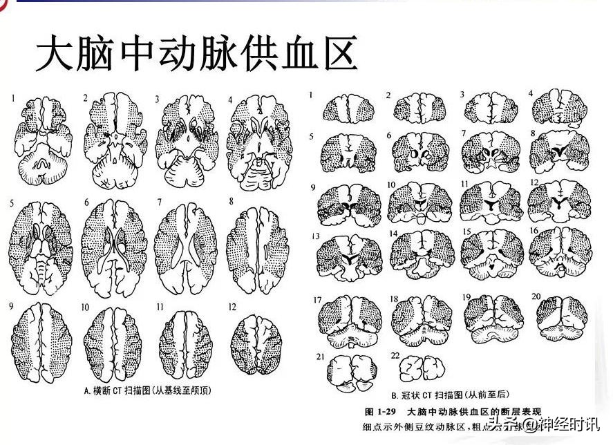脑动脉解剖学讲解,脑膜中动脉解剖讲解