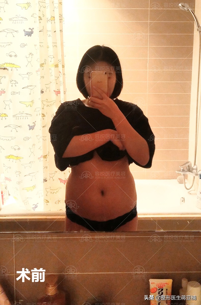 全身吸脂18斤需要多少钱,8000的面部吸脂