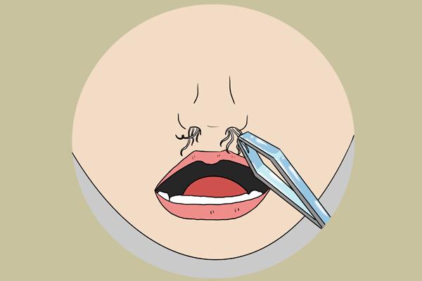 鼻毛长得快是什么原因导致的,为什么鼻毛会从喉咙出来