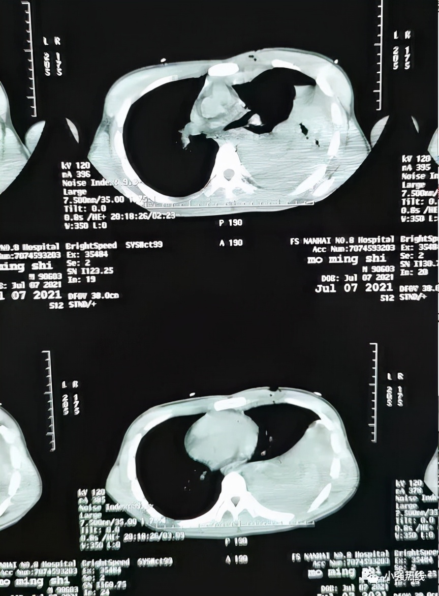 太狠了一剑刺穿心爱的人,小伙胸口被刀捅人事件