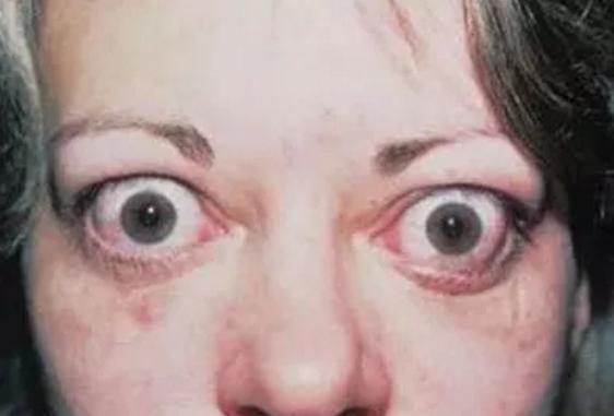 甲亢突眼该如何治疗最好,甲亢突眼该怎么治疗好的快些