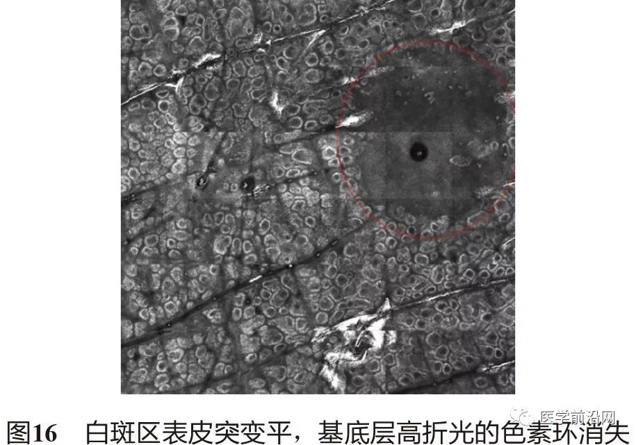 皮肤共聚焦显微镜能查什么,皮肤镜和共聚焦显微镜
