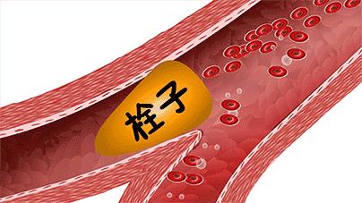 40岁高血压冠状动脉粥样硬化,40岁人就有高血压怎样解决