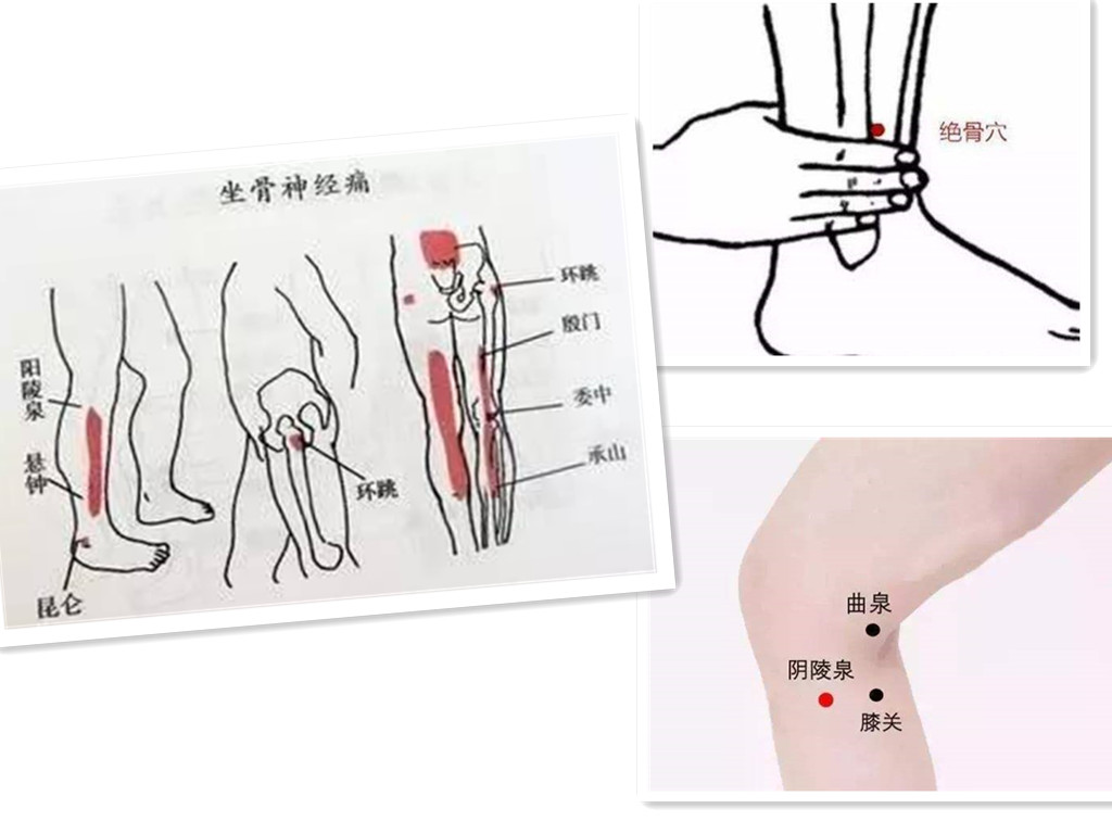 坐骨神经痛起不了床怎么办呢,坐骨神经痛怎么治疗有哪些偏方