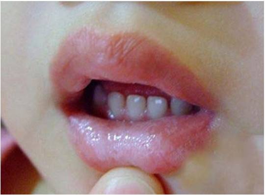 宝宝嘴里有小白点底下红的,一个月宝宝口腔上颚白色的是什么