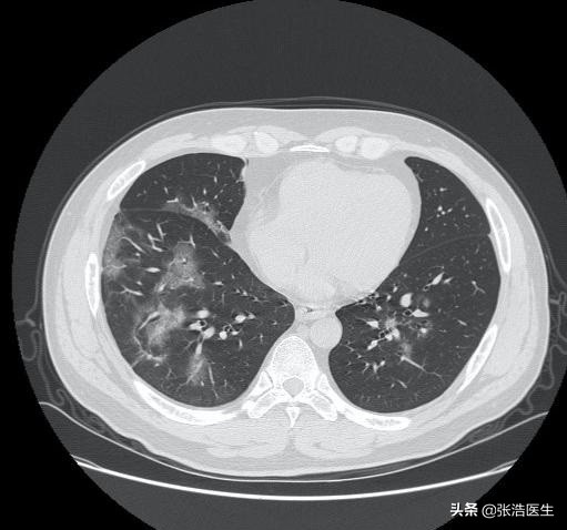 病毒感染和细菌感染发热的区别,病毒感染发热和细菌感染发热区别