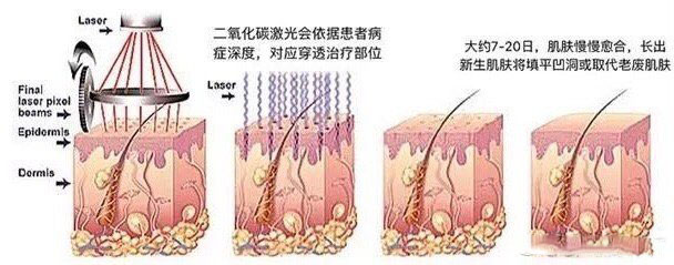 去眼部脂肪粒的最好方法,祛眼部脂肪粒最有效的方法