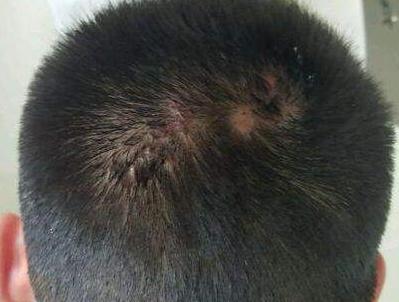 前胸后背长痘痘是毛囊炎吗,前胸后背很容易长痘痘中医治疗