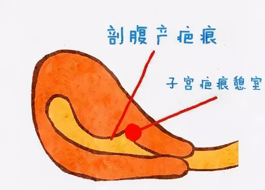 子宫疤痕憩室会引起腹痛吗,疤痕性子宫憩室手术后遗症