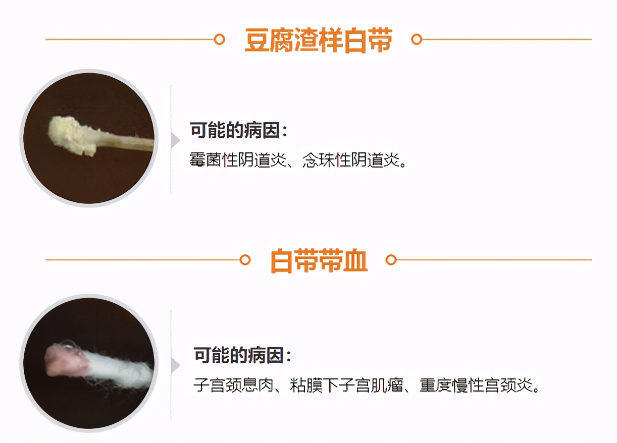 白带发黄是什么问题几天会结痂,白带发黄粘稠是什么病的前兆呢