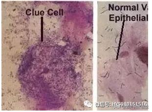 阴道清洁度如何解读？出现异常如何治疗和预防？