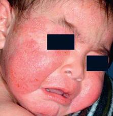 宝宝湿疹严重妈妈吃什么食疗,湿疹的分类及应对方法