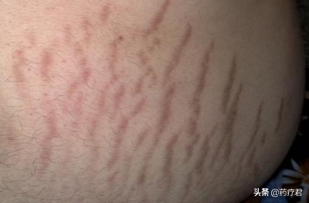 灏忎紮鑳屼笂闀挎枒椹嚎,14宀佺敺瀛╄儗涓婃儕鐜版枒椹嚎