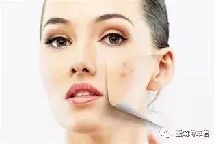 什么办法去除满背痘,去痘干货