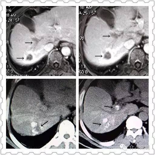 肝癌门静脉癌栓能做介入手术吗,肝癌门静脉癌栓中医治疗