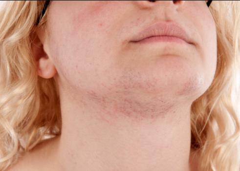 激素药膏用在脸上不得超过多久,激素药膏擦多了会烂脸吗