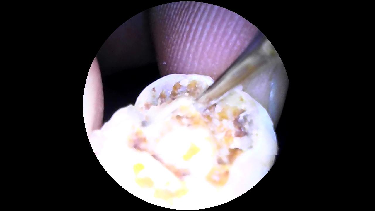 500万超声波洁牙器,素诺智能可视超声波洁牙仪t13pro