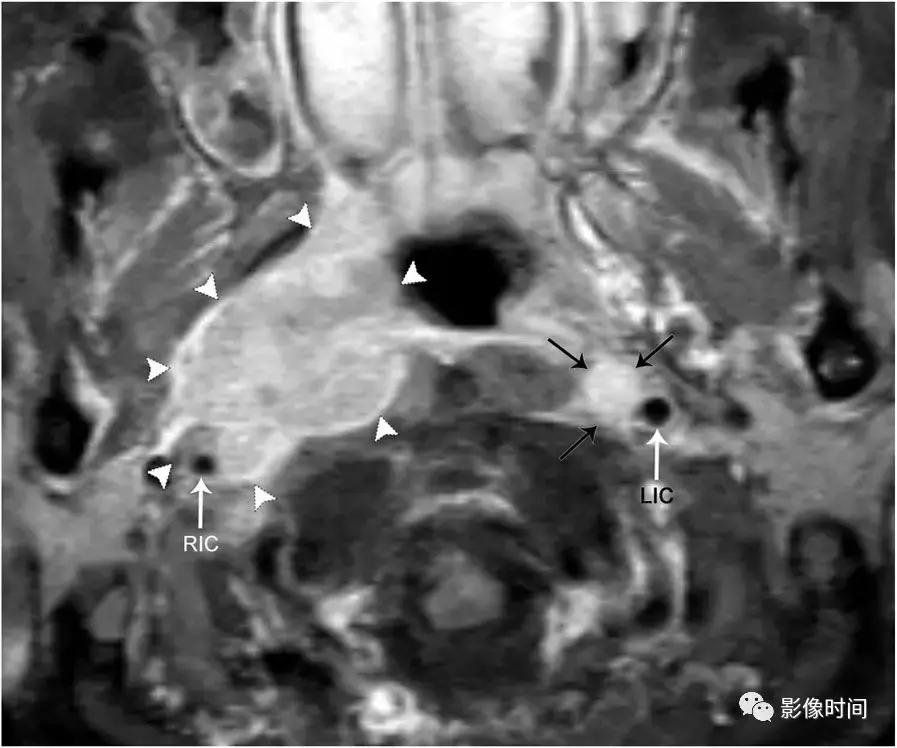 双侧颈动脉鞘间隙多发小淋巴结影,双侧颈动脉间隙多软组织密度结节
