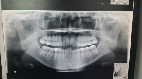 吃饭咬到腮帮怎么好得快,吃东西咬到腮帮是上火吗