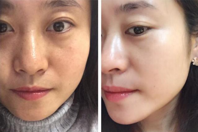 美白针是正规的吗,美白针的风险