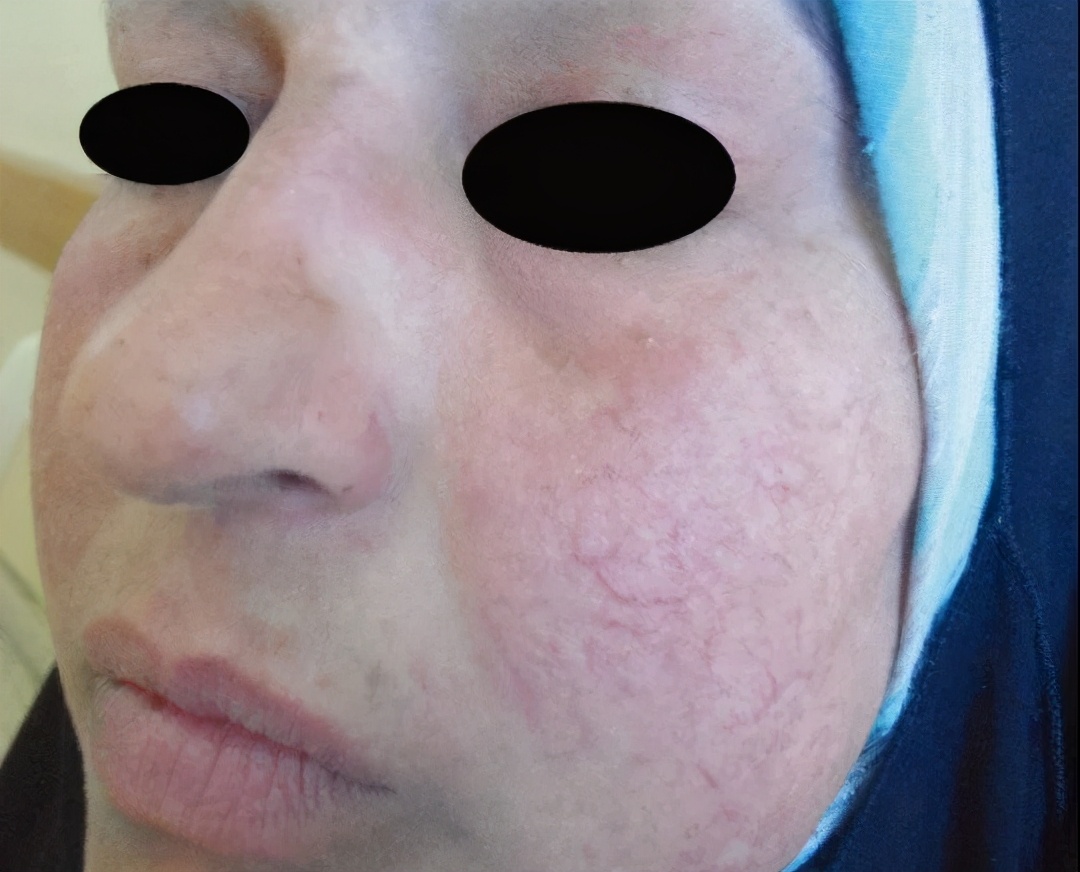 激素依赖性皮炎医院开的方子,华山皮肤科激素依赖性皮炎