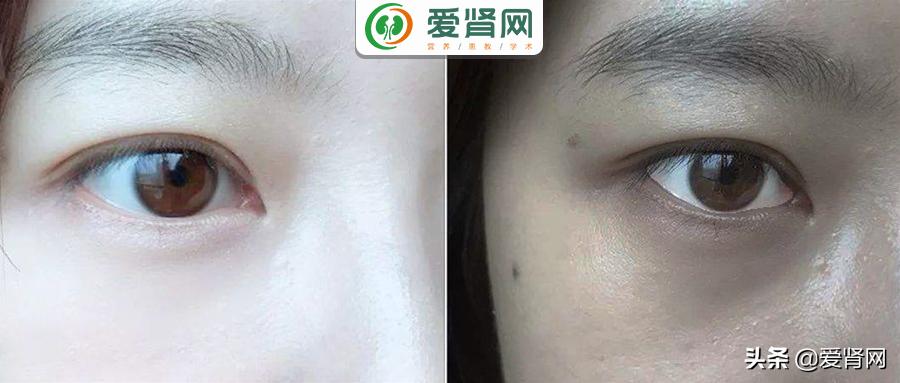 肾衰竭透析皮肤变黑怎么改善,肾透析后皮肤很干燥怎么办