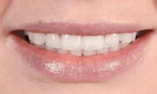 现在矫正牙技术成熟吗,矫正牙齿不要花冤枉钱