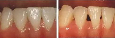 为什么牙齿黑三角不可逆,黑三角是不可逆的吗