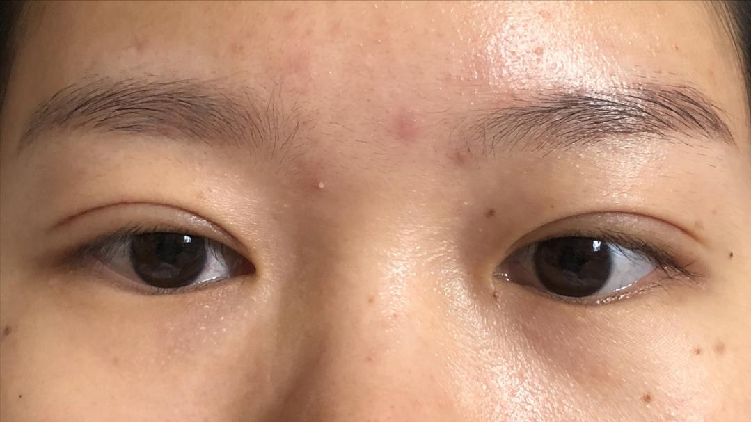 做双眼皮花了15000贵了吗,做个双眼皮手术30000块钱贵吗