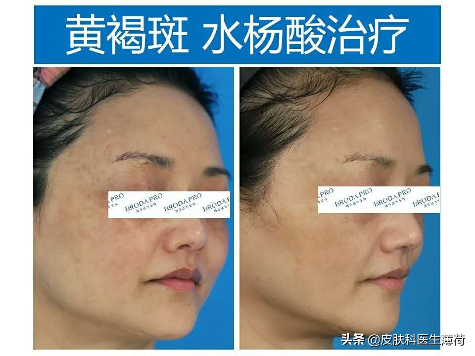 水杨酸果酸毛孔收缩精华测评,水杨酸精华适合所有痘肌