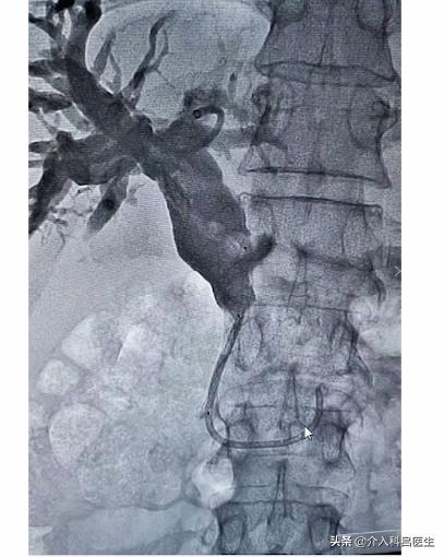 肿瘤导致黄疸,肝脏肿瘤压迫胆管应怎样治疗