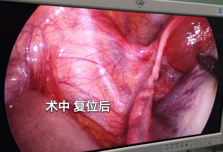 怀孕初期卵巢囊肿扭转怎么办,怀孕了查出来卵巢囊肿需要手术吗