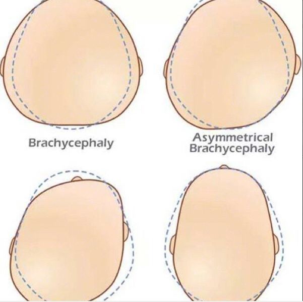 颅顶高扁头怎么睡成圆头,如何拯救高颅顶大扁头